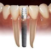 Post Operative Splints Surgery saravana dental clinic thiruthuraipoondi and vedaranyam